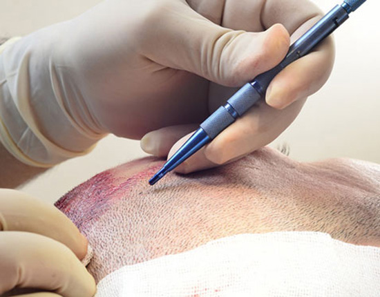 sapphire-fue-hair transplantation